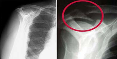 impingement