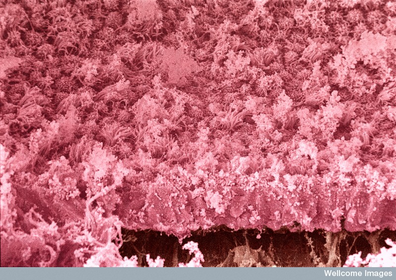 Endometriosis on an ovarian cyst. Colour-enhanced, scanning electron micrograph of endometriosis. A layer of endometrial epithelium (pink) can be seen growing on an ovarian cyst (brown). Ciliated and secretory cells are visible as well as considerable fibrin debris.