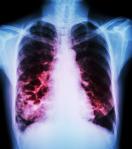 chest x-ray